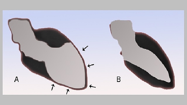 TakoTsubo scheme by JHeuser